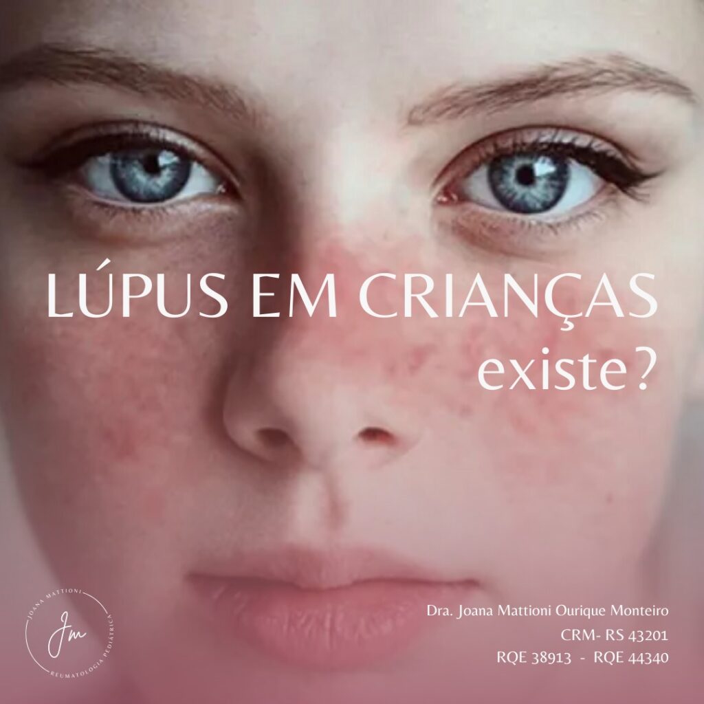 Lupus em criança existe?